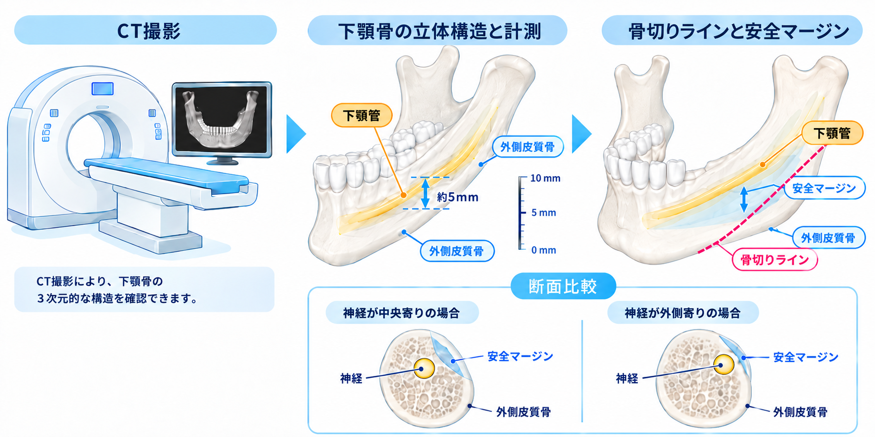 術前3D-CT検査で神経の走行をどこまで把握できるか