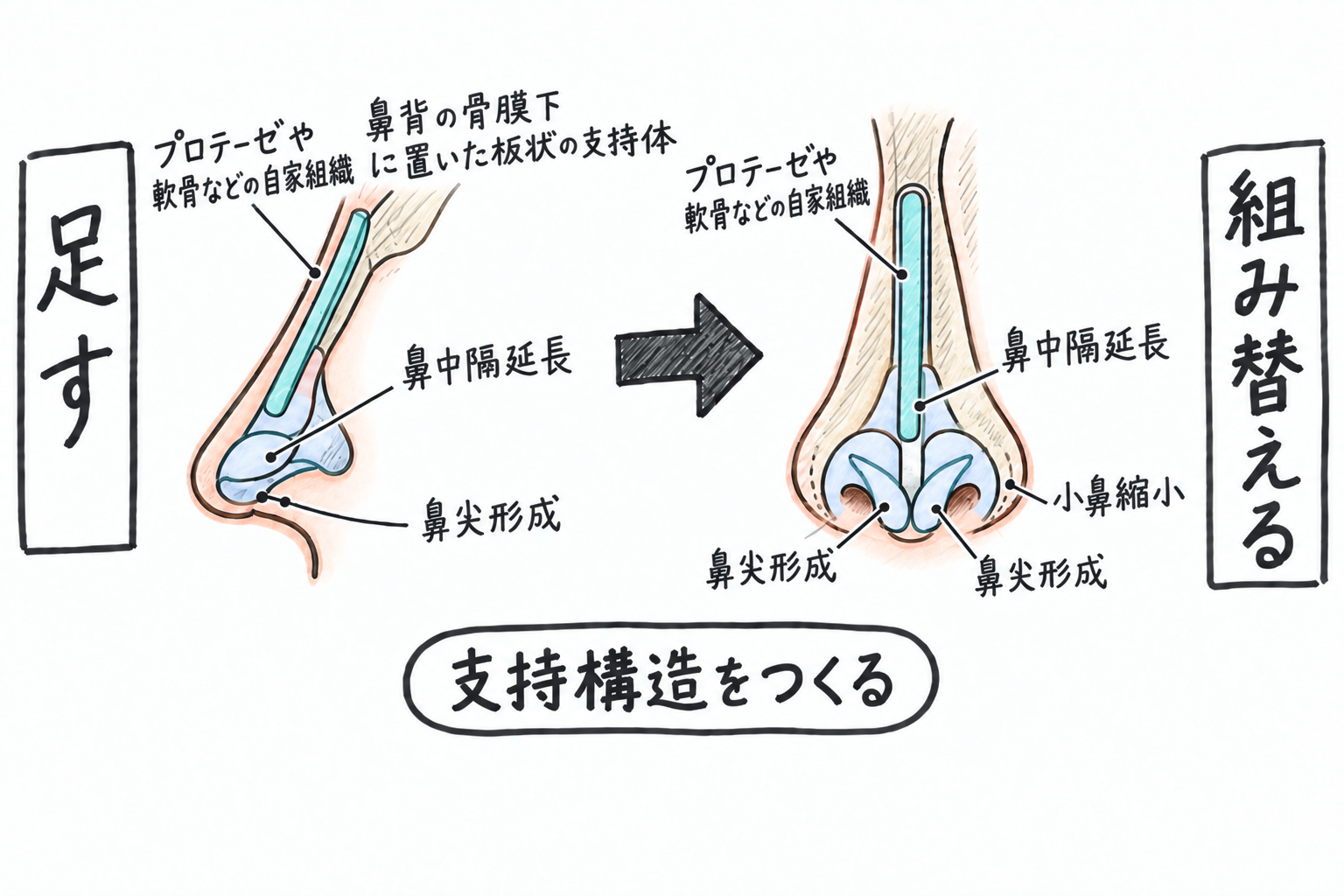 手術でなければ変えられない部位—鼻尖形成・プロテーゼや自家組織移植・小鼻縮小の役割