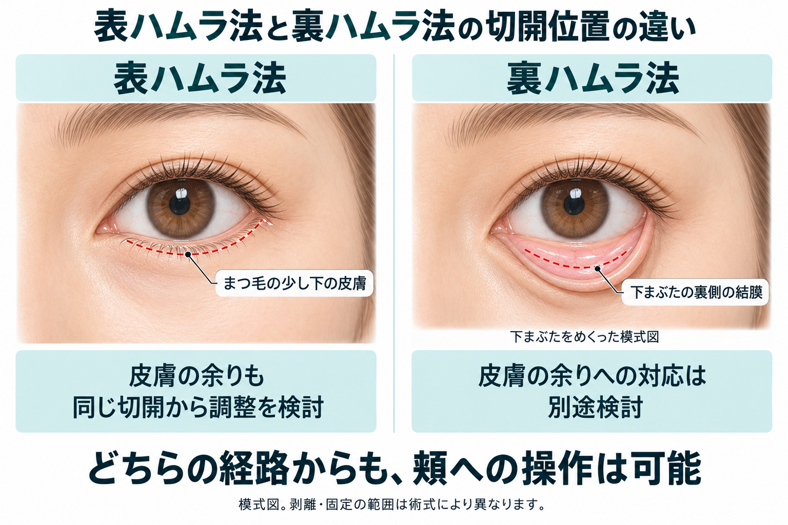 まつ毛の下と結膜側、それぞれの切開経路で何が変わる？